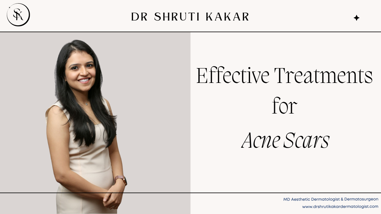 Effective Treatments for Acne Scars