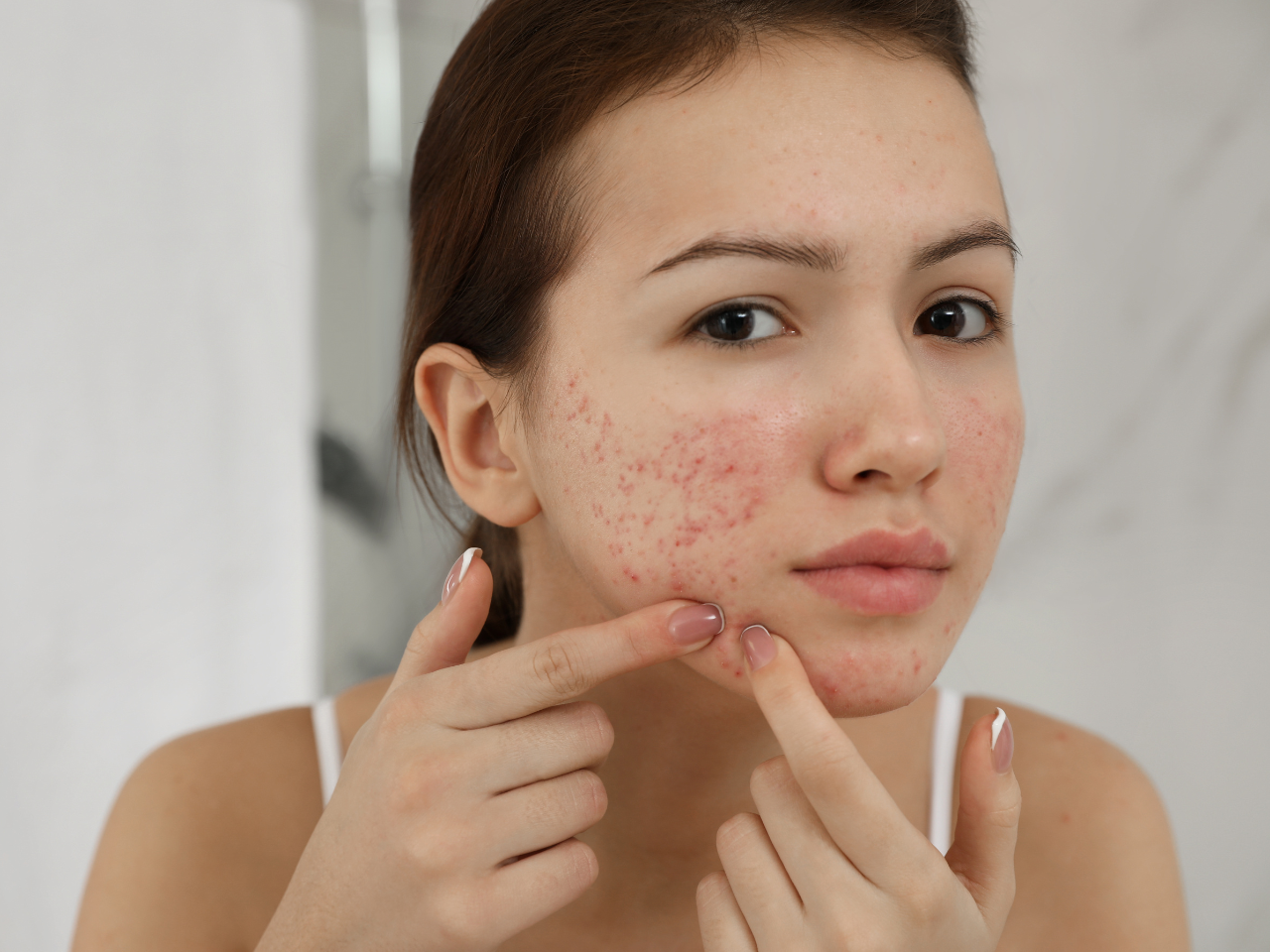 Acne Scar Treatment | Dr Shruti Kakar